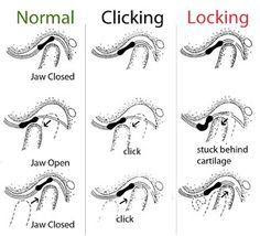 normal, clicking, and locking of jaw diagram